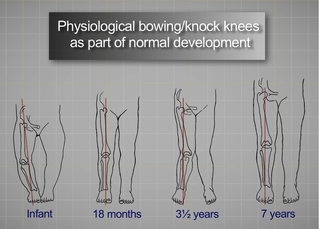 Lower Limb Normal Variants | Doctor - PMM